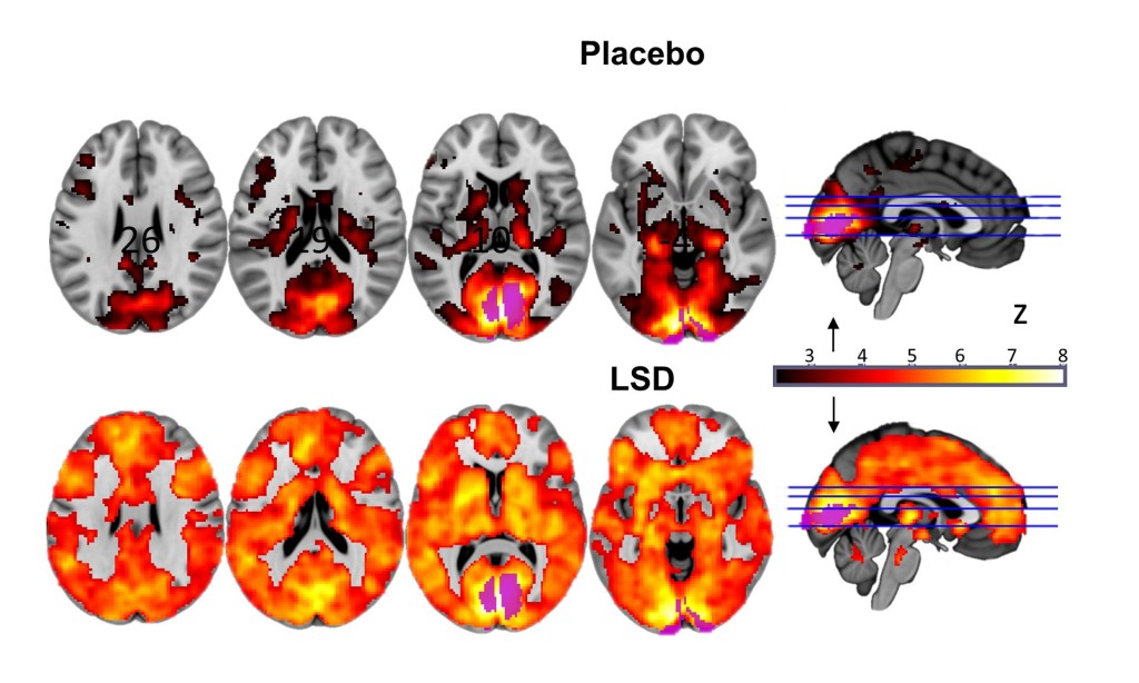 השפעות LSD על המוח